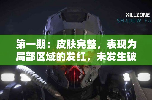 第一期：皮肤完整，表现为局部区域的发红，未发生破损。